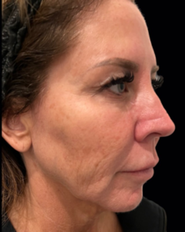 Full Facial Rejuvenation Before & After Image