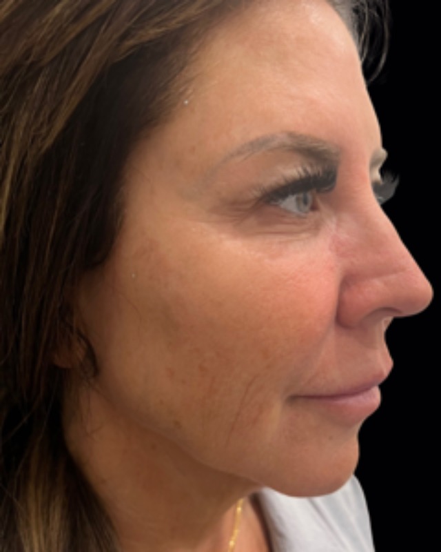 Full Facial Rejuvenation Before & After Image