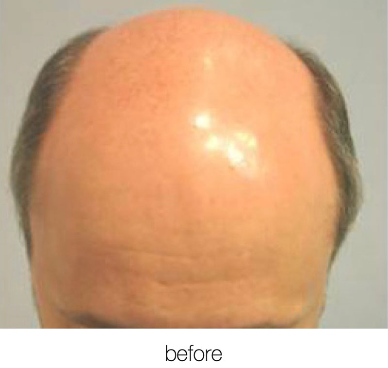FUE NeoGraft Before & After Image