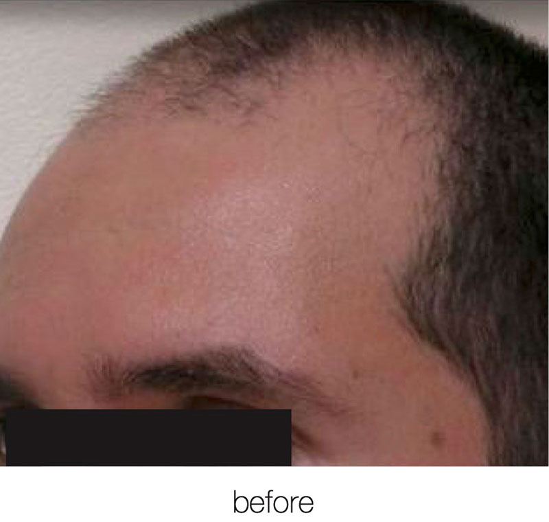 FUE NeoGraft Before & After Image