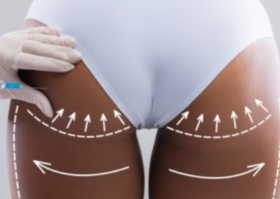 Non-Surgical Brazilian Butt Lift